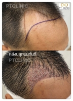 S__146047030.jpg - ปลูกผม | https://ptinfinity.com