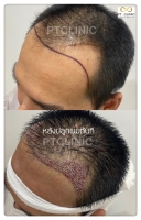 S__146047033.jpg - ปลูกผม | https://ptinfinity.com