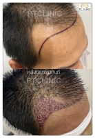 S__146047035.jpg - ปลูกผม | https://ptinfinity.com