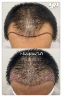 S__146047036.jpg - ปลูกผม | https://ptinfinity.com