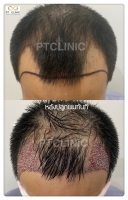 S__146047037.jpg - ปลูกผม | https://ptinfinity.com