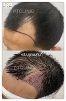 S__146047038.jpg - ปลูกผม | https://ptinfinity.com