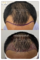 S__146047040.jpg - ปลูกผม | https://ptinfinity.com