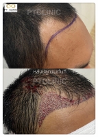 S__146047041.jpg - ปลูกผม | https://ptinfinity.com