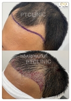 S__146047042.jpg - ปลูกผม | https://ptinfinity.com