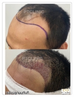 S__146047043.jpg - ปลูกผม | https://ptinfinity.com