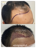 S__146047044.jpg - ปลูกผม | https://ptinfinity.com