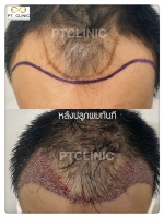 S__146047046.jpg - ปลูกผม | https://ptinfinity.com