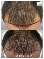 S__146047047.jpg - ปลูกผม | https://ptinfinity.com