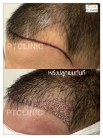 S__146047048.jpg - ปลูกผม | https://ptinfinity.com