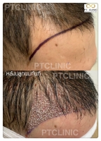 S__146047049.jpg - ปลูกผม | https://ptinfinity.com