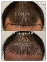 S__146047054.jpg - ปลูกผม | https://ptinfinity.com