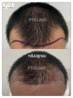 S__146047055.jpg - ปลูกผม | https://ptinfinity.com