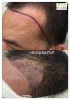 S__146047056.jpg - ปลูกผม | https://ptinfinity.com