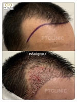 S__146047057.jpg - ปลูกผม | https://ptinfinity.com