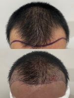 S__146047058.jpg - ปลูกผม | https://ptinfinity.com