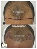 S__146047059.jpg - ปลูกผม | https://ptinfinity.com