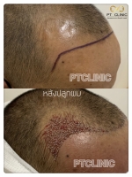 S__146047060.jpg - ปลูกผม | https://ptinfinity.com