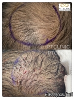 S__146047063.jpg - ปลูกผม | https://ptinfinity.com