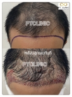 S__146047065.jpg - ปลูกผม | https://ptinfinity.com