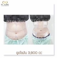 S__146047007.jpg - บริการดูดไขมัน 3,800 CC | https://ptinfinity.com