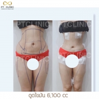 S__146047107.jpg - บริการดูดไขมัน 3,800 CC | https://ptinfinity.com