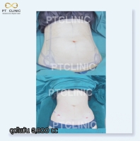 S__146047111.jpg - บริการดูดไขมัน 3,800 CC | https://ptinfinity.com