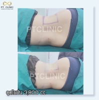 S__146047114.jpg - บริการดูดไขมัน 3,800 CC | https://ptinfinity.com