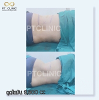 S__146047116.jpg - บริการดูดไขมัน 3,800 CC | https://ptinfinity.com