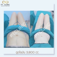S__146047117.jpg - บริการดูดไขมัน 3,800 CC | https://ptinfinity.com
