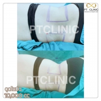 S__146972690.jpg - วันนี้เราจะมารีวิวดูดไขมัน #PTCLINIC ค้า | https://ptinfinity.com