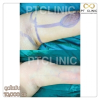 S__146972691.jpg - วันนี้เราจะมารีวิวดูดไขมัน #PTCLINIC ค้า | https://ptinfinity.com