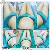 S__146972692.jpg - วันนี้เราจะมารีวิวดูดไขมัน #PTCLINIC ค้า | https://ptinfinity.com