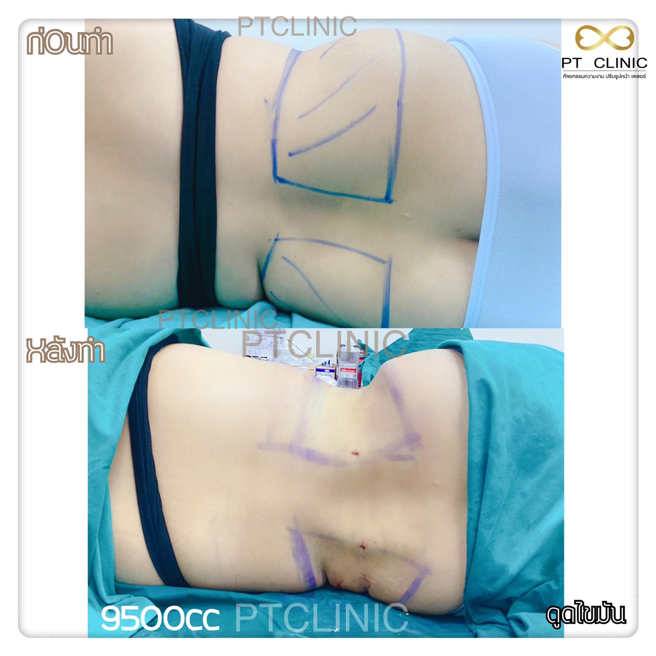 8 - https://ptinfinity.com | PT CLINIC ศัลยกรรมความงาม ปรับรูปหน้า เลเซอร์