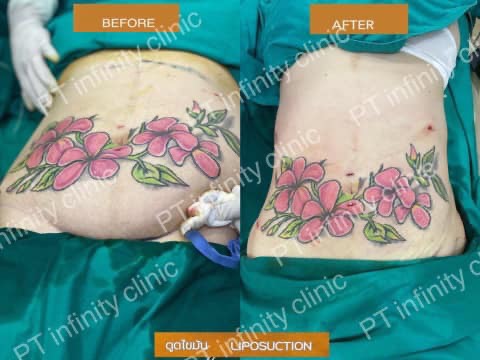 a1 - https://ptinfinity.com | PT CLINIC ศัลยกรรมความงาม ปรับรูปหน้า เลเซอร์