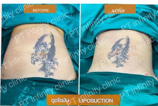 a2 - https://ptinfinity.com | PT CLINIC ศัลยกรรมความงาม ปรับรูปหน้า เลเซอร์