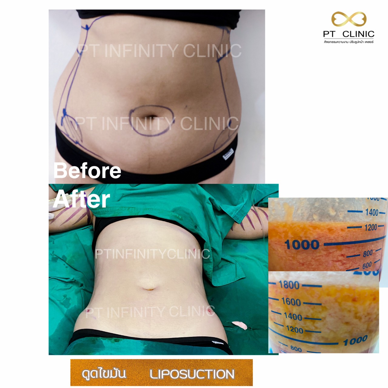 a5 - https://ptinfinity.com | PT CLINIC ศัลยกรรมความงาม ปรับรูปหน้า เลเซอร์