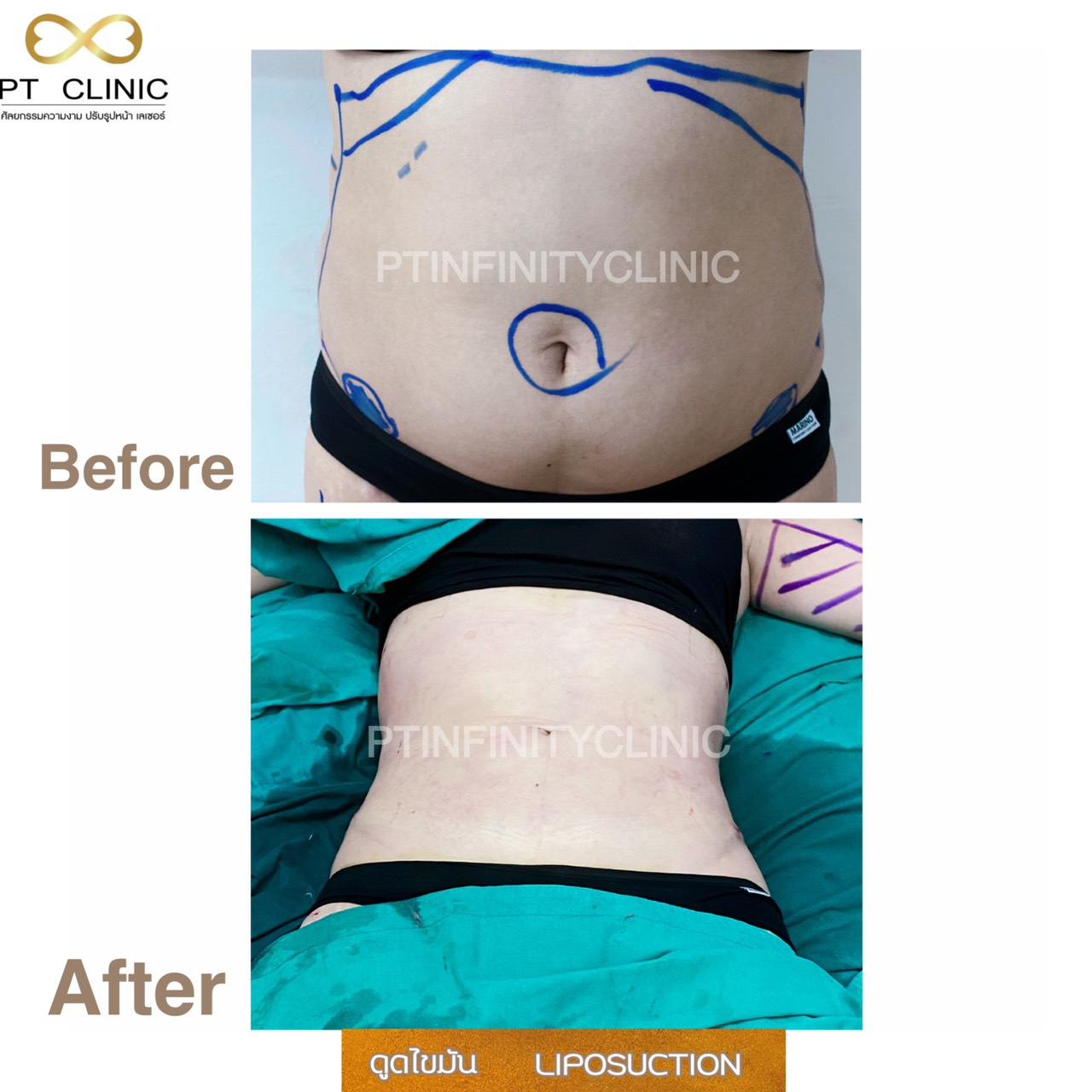 a6 - https://ptinfinity.com | PT CLINIC ศัลยกรรมความงาม ปรับรูปหน้า เลเซอร์