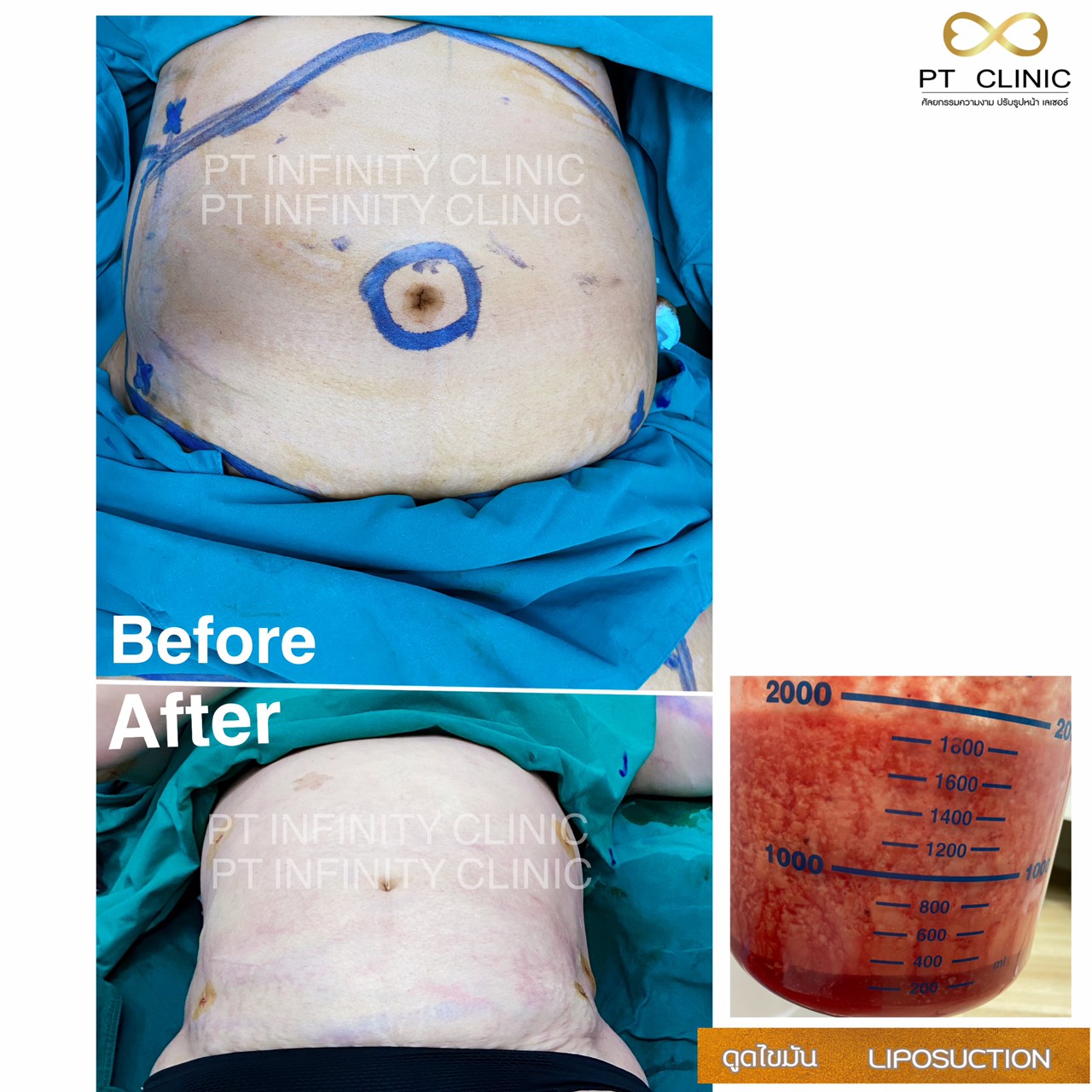 a9 - https://ptinfinity.com | PT CLINIC ศัลยกรรมความงาม ปรับรูปหน้า เลเซอร์