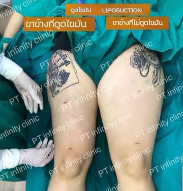 b2 - https://ptinfinity.com | PT CLINIC ศัลยกรรมความงาม ปรับรูปหน้า เลเซอร์