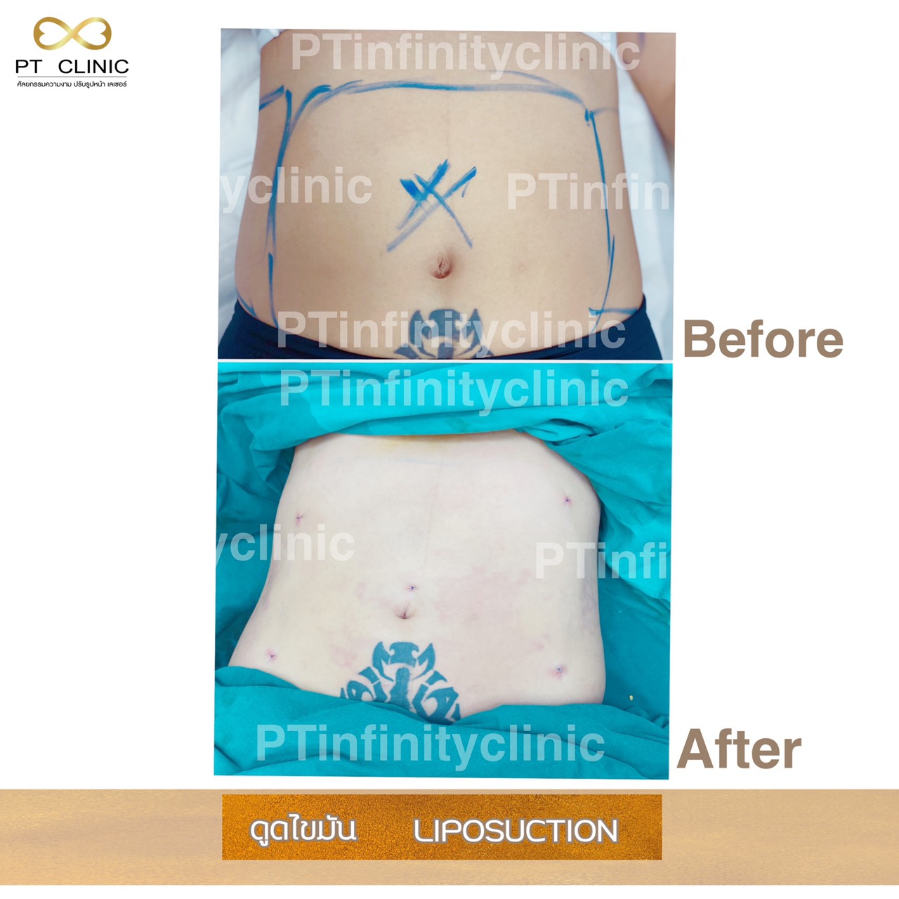 b6 - https://ptinfinity.com | PT CLINIC ศัลยกรรมความงาม ปรับรูปหน้า เลเซอร์