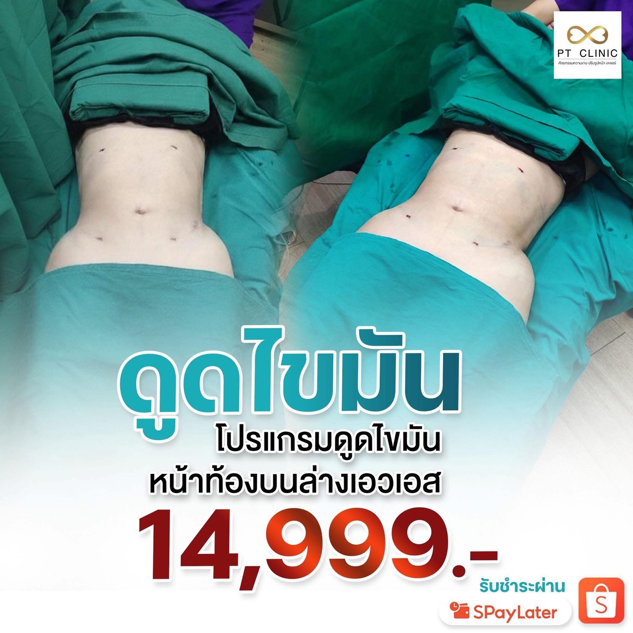 ดูดไขมัน โปรแกรมดูดไขมันหน้าท้องบนล่างเอวเอส